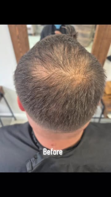 men's hair systems at hairinxs call for a free consultation#malepatternbaldness #baldmen #menshairsy
