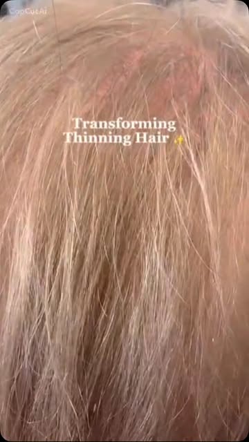 Don't suffer in silence we have a solution to your problem#hairloss #beforeandafter #confidenceboost