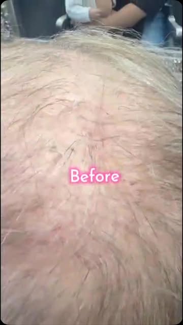 Don't suffer in silence have hair today#hairloss #confidenceboost #alopecia #femalepatternbaldness #