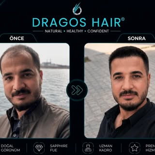 Gerçek sonuçlar, doğal görünüm. ✨
Her saç ekimi kişiye özel planlanır ve doğal saç çizgisi hedefleni