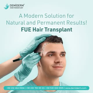 The FUE method is a modern technique used to harvest individual hair follicles and achieve a natural