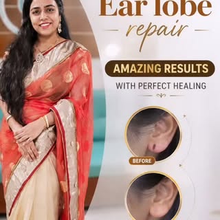 ✨👂 EARLOBE REPAIR MAGIC! 👂✨
Amazing results. Beautiful healing. 💫
A month after Earlobe Repair, t
