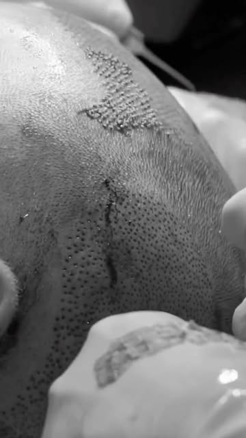 La implantación de folículos se hace de manera manual y folículo a folículo.👏🏻

El número de folíc