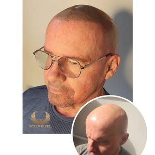 **Scalpelite change des vies** ✨ 

Notre client souffrait d’**alopécie totalis** — pas un seul cheve