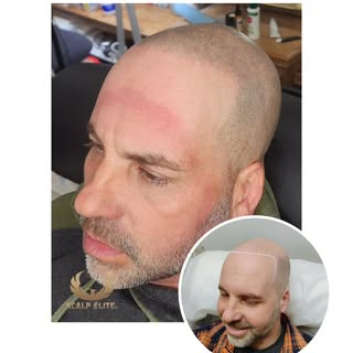 SMP Scalp Elite 💥💪

La micropigmentation capillaire change des vies. Mon client, dans la quarantai