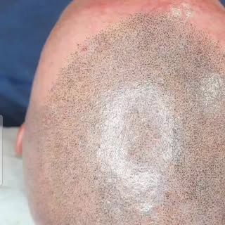 Hairline Rain technique

Info@cliniquescalpelite.com 

#ScalpMicropigmentation #smpterrebonne #smpmo