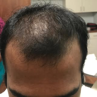 PLACEMENT PHOTO!!!! Richmond VA. This patient received 2200 grafts FUT method. We specialize is DENS