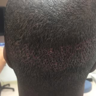 FUE on Afro American.  Many places steer away from this procedure on this hair type due to the natur