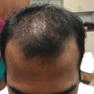 PLACEMENT PHOTO!!! This patient received 2200 grafts FUT method. We specialize in DENSITY!!