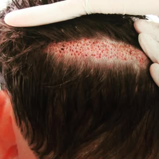 The “Camouflage” FUE. No one has to know!. No more Shaved Head! (For smaller procedures) #prphairres