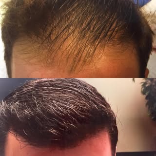 👀👀👀 With just a day in our chair! #prphairrestoration #hairrestoration #hairtransplant #virginiab