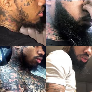ANOTHER Beard!!🧔. We specialize in ALL hair types! This patient received 1500 grafts FUT to fulfill