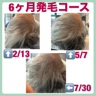 当院に通われているお客様の成果です✨

70代女性

発毛コース2月13日スタート

3ヶ月後

約5ヶ月半後の7/30までのお写真です！

髪がしっかり立ちボリュームも多くなってきました。

大体3