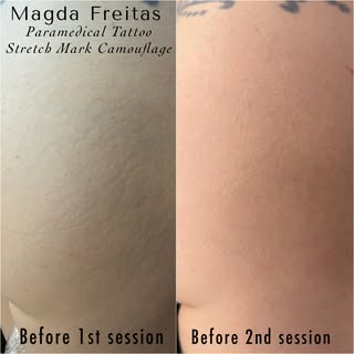 If you’ve ever felt self-conscious about stretch marks, you deserve a solution that looks refined—no