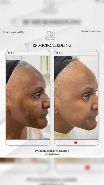 Lift, tighten, and resurface. The ultimate 3-in-1 skin transformation. 🔄✨
Usually, treating deep ac
