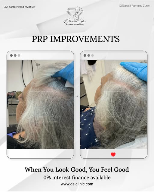 Seeing more scalp than you used to? Let’s reverse it. 🪞💎
The best part about our advanced Hair PRP