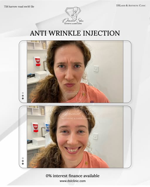 Look Rested. Never Frozen. ✨💎
The biggest myth about anti-wrinkle injections? That they will leave 