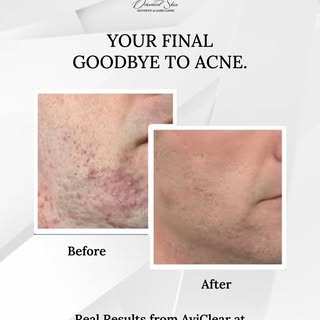 Stop hiding behind heavy makeup. Reclaim your bare skin. 🪞💎
Dealing with persistent acne isn’t jus