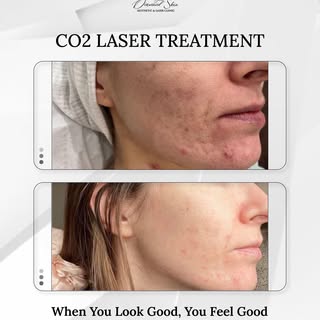 Hit the ultimate reset button on your skin. 🔄💎
Standard skincare routines and gentle facials can o
