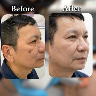 Peel away the past and reveal your most radiant skin. 🦋✨
True skin resurfacing isn’t just about tre