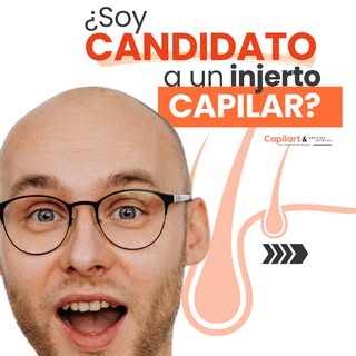 No todo el mundo con alopecia necesita un injerto capilar… y no todos los candidatos lo necesitan en