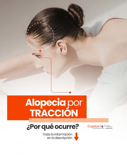 ¿Llevas siempre el pelo muy tirante? Tu peinado podría estar hablando por tu cuero cabelludo.

La al