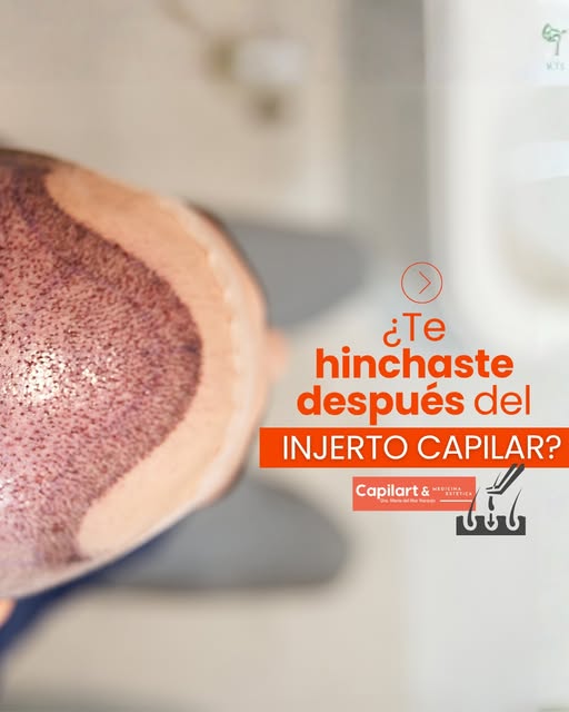 ¿Te hinchaste después del injerto capilar? Es algo que puede ocurrir durante los primeros días.

Tra