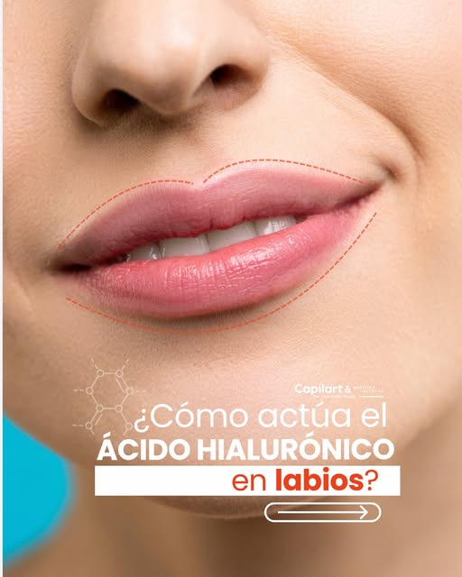 Ácido hialurónico en labios: no todo es dar volumen.

Uno de los grandes beneficios del ácido hialur