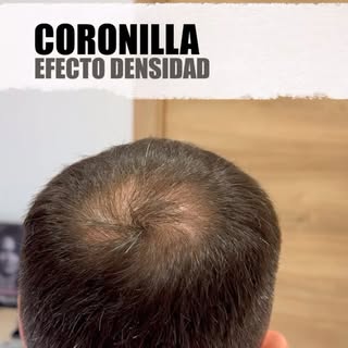Muchos piensan que la micropigmentación capilar consiste en hacer puntos.

No.

Consiste en consegui