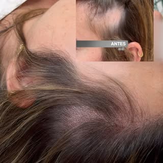 No toda la pérdida de cabello es una alopecia común. 

En este caso tratamos una alopecia triangular