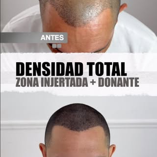 DENSIDAD TOTAL. 🔋

Este paciente ya se había sometido a un injerto capilar, pero todavía quería un 
