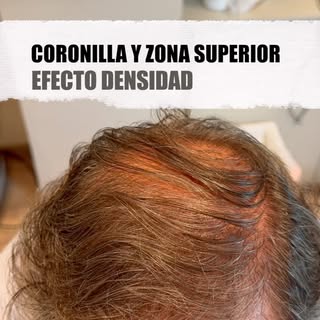 ✨ EFECTO DENSIDAD | CORONILLA Y ZONA SUPERIOR

En este caso trabajamos sobre un paciente con cabello