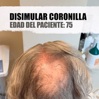 Hay decisiones que no tienen edad.

A los 75 años, este paciente no quería parecer otra persona. Sol