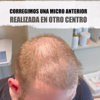 No todos los tratamientos salen como uno espera.

Este paciente ya se había realizado dos micropigme