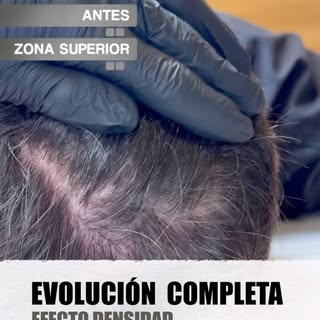 Un injerto capilar puede cambiar mucho la imagen, pero no siempre consigue la densidad deseada.

En 