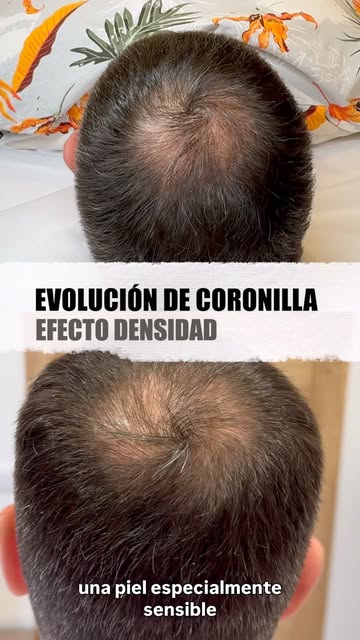Evolución real de un tratamiento de micropigmentación capilar en coronilla · efecto densidad.

Partí