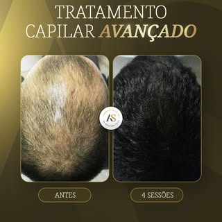Tratamento com resultados reais? Eu te mostro!

Esse procedimento teve esse resultado com 4 sessões 