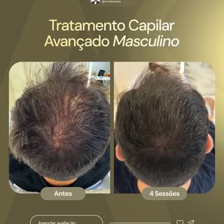 A alopecia androgenética é uma condição progressiva.
Isso significa que, sem acompanhamento adequado