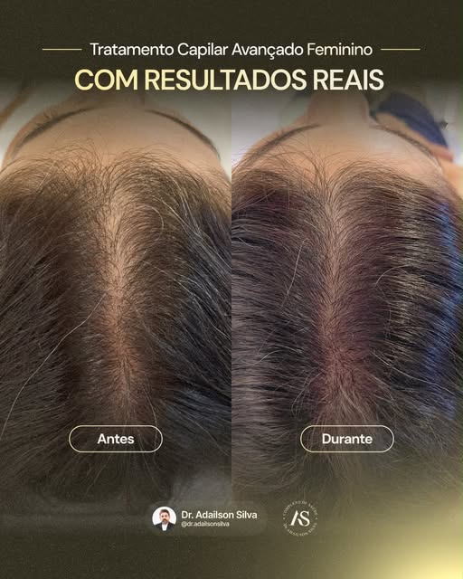 Seu cabelo passa por ciclos naturais.💆🏻‍♂️✨
Por isso nem toda queda é igual, e em alguns casos, el