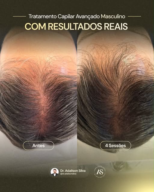 Existe uma diferença enorme entre esconder o problema e decidir cuidar dele.💆🏻‍♂️✨
O primeiro traz