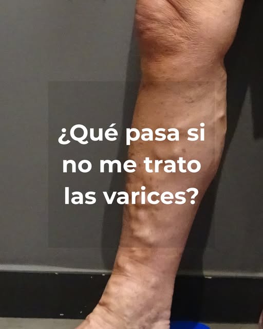 ¿Qué pasa si no se tratan las varices?

Así de entrada…nada. Sobre todo, cuando no hay síntomas mole