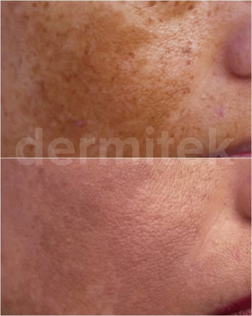 Esta paciente acudió a consulta con un caso de melasma muy difícil de tratar por el grado de pigment