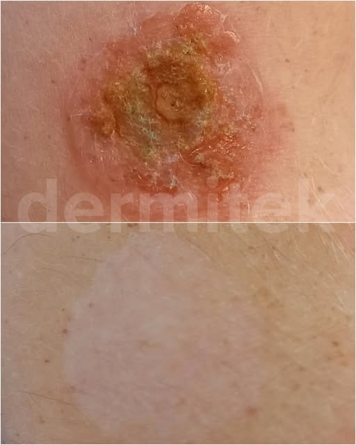 El impétigo es especialmente frecuente durante los meses de calor en niños y niñas.

Es una infecció