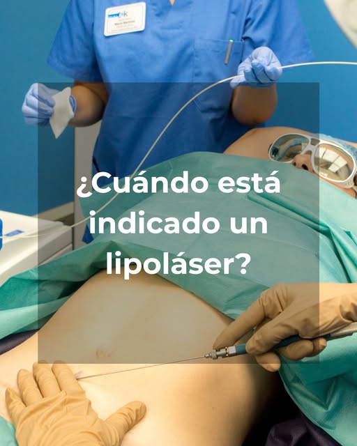 El lipoláser o liposucción asistida por láser elimina acúmulos de grasa localizada, esa que no se va