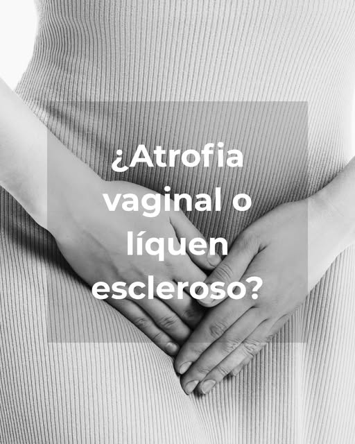 Los síntomas del liquen escleroso y atrófico se confunden habitualmente con los de la atrofia vagina