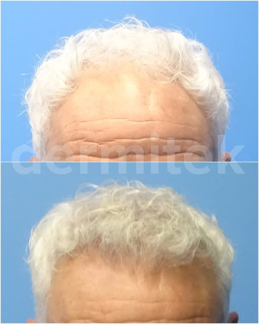 ¿Se puede hacer un injerto capilar una persona con el pelo canoso?

Aquí tenéis la respuesta: cerca 