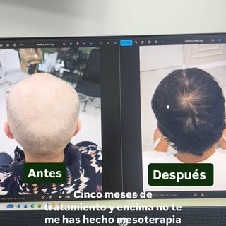 Se rapaba desde antes de los 25 años… 
En @alopeciacit no solo vemos cabello.
Vemos personas, histor