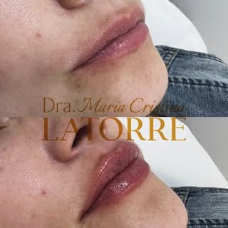 Armonía, hidratación y volumen natural. 💋 
El objetivo no es exagerar, sino respetar la anatomía y 