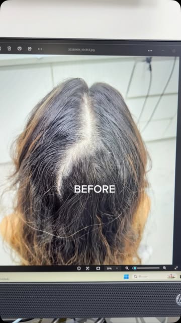 Mejora tu salud capilar aqui en @alopeciacit ✨🤍🫶🏻
#saludcapilar #tricología #alopecia #alopeciafe