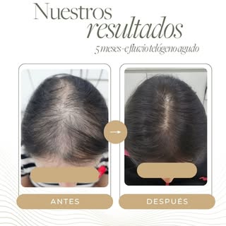 ¡Qué duro es el efluvio telógeno agudo!
¿Sabías que a todos nos puede suceder? 

Te explico su histo